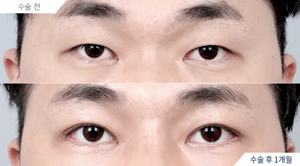 Before/After