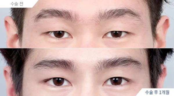 Before/After