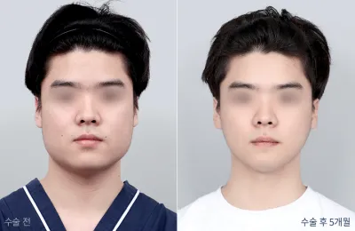 Before & After