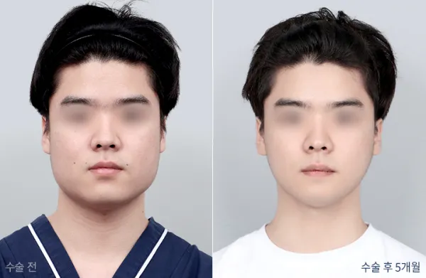 Before/After