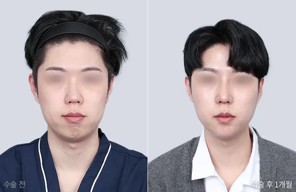 Before/After