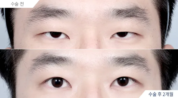 Before/After