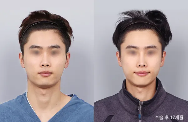 Before/After