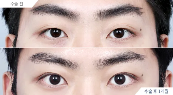 Before/After
