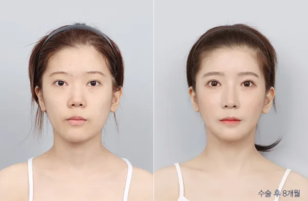 Before/After