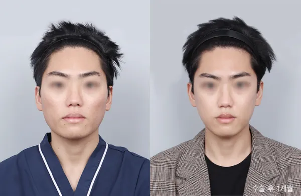 Before/After