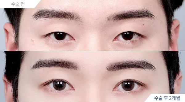 Before/After