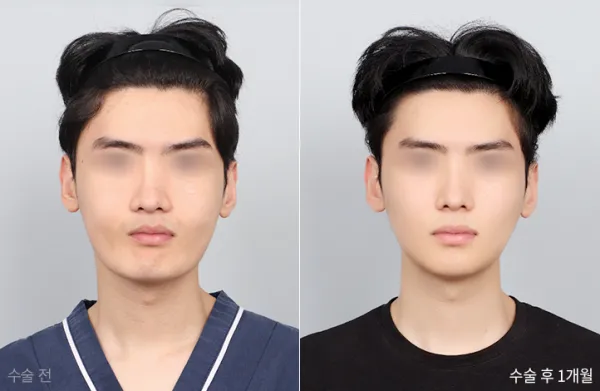 Before/After