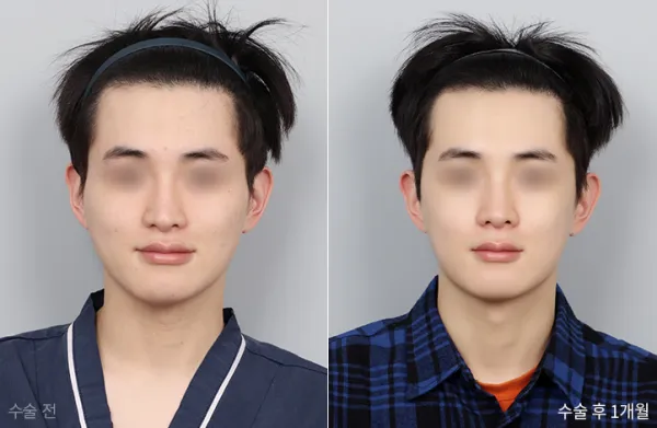 Before/After