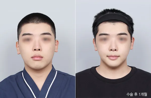 Before/After