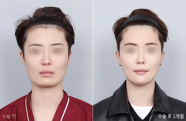 Before/After