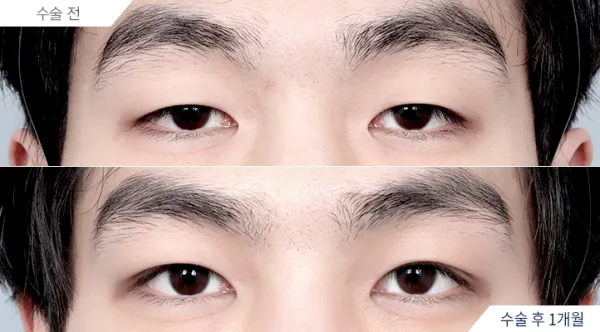 Before/After