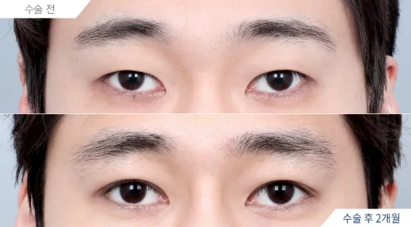 Before/After