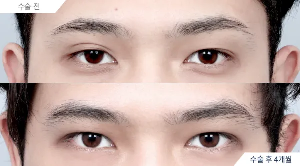Before/After