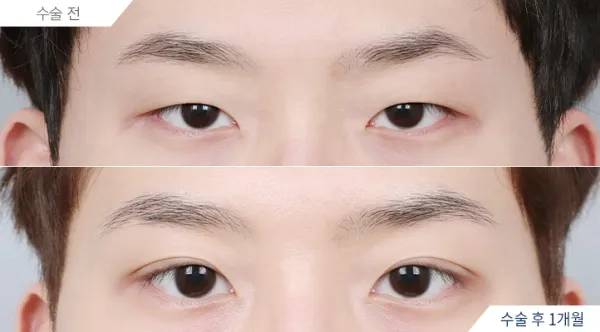 Before/After