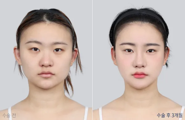 Before/After