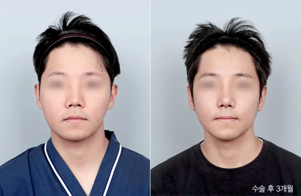 Before/After
