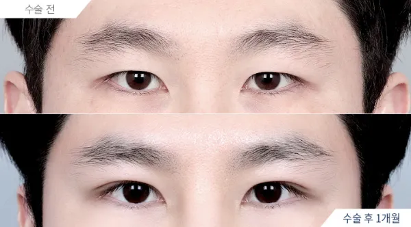 Before/After