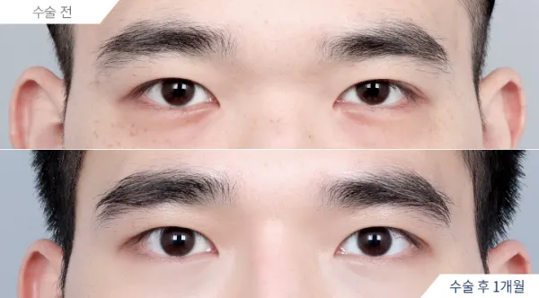 Before/After