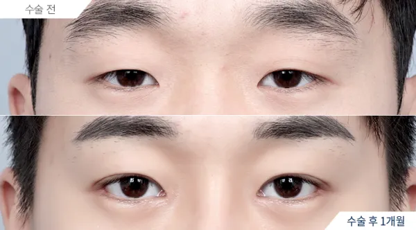 Before/After