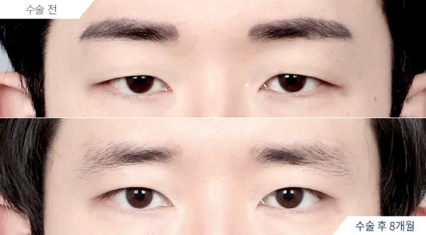 Before/After