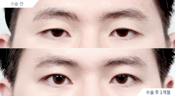 Before/After