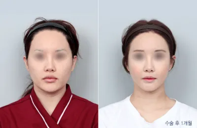 Before & After