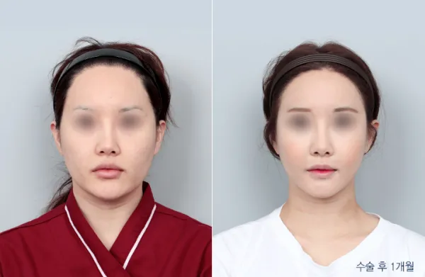 Before/After