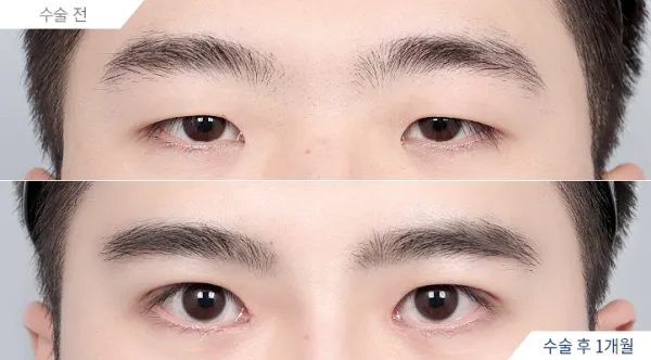 Before/After