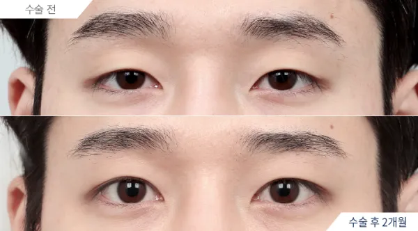 Before/After
