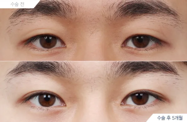 Before/After
