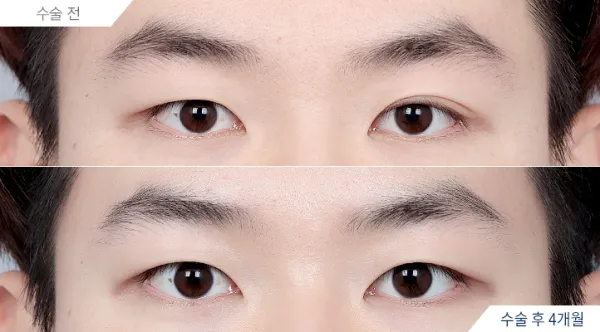 Before/After