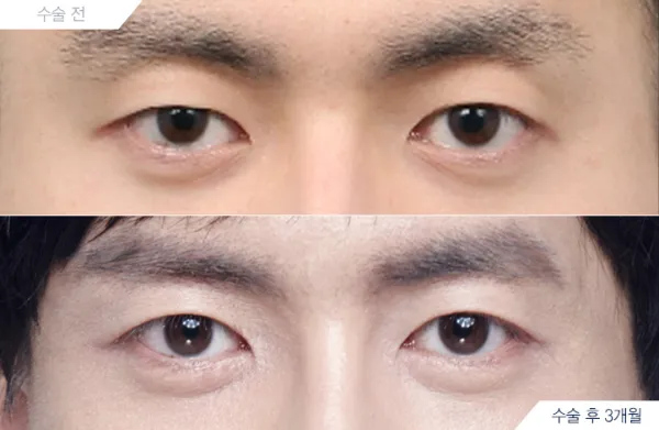 Before/After