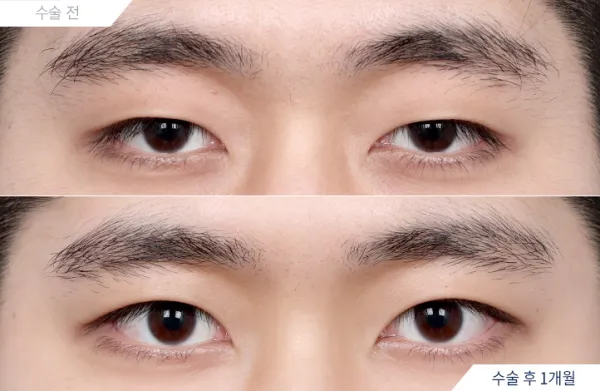 Before/After