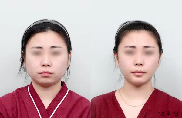 Before/After