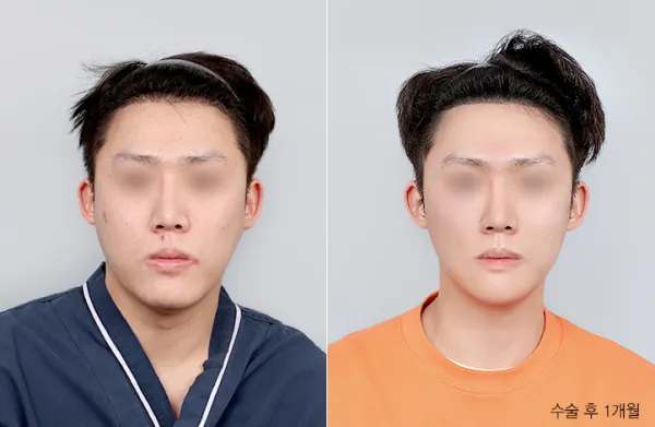 Before/After