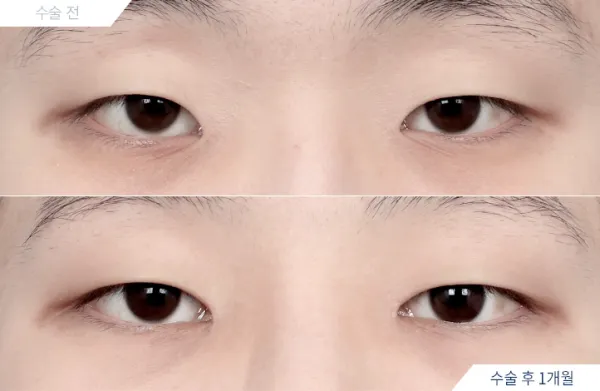 Before/After