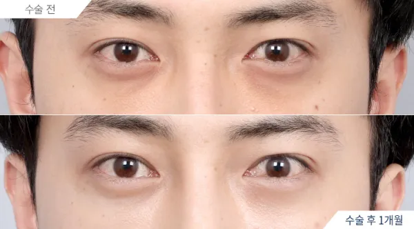 Before/After