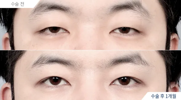 Before/After
