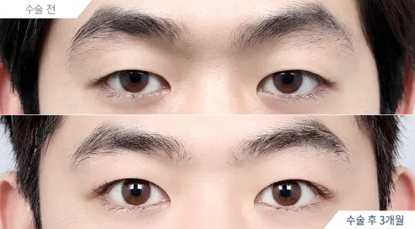 Before/After