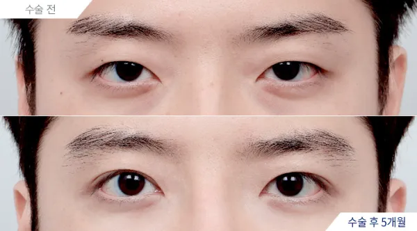 Before/After