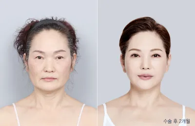 Before & After