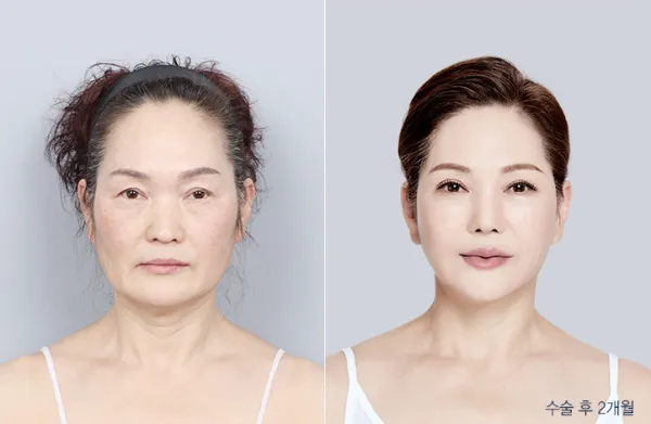 Before/After