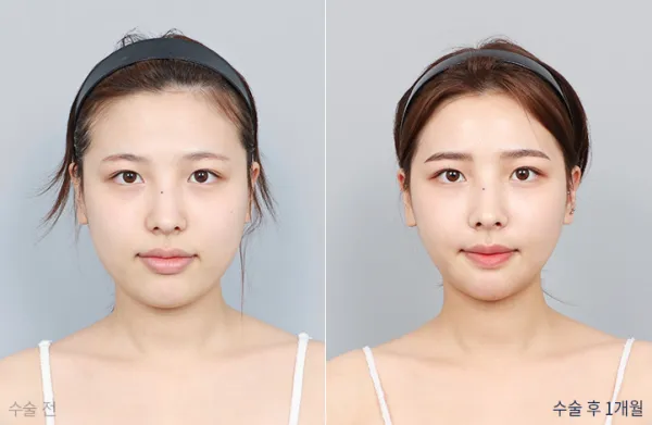 Before/After