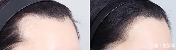 Before/After