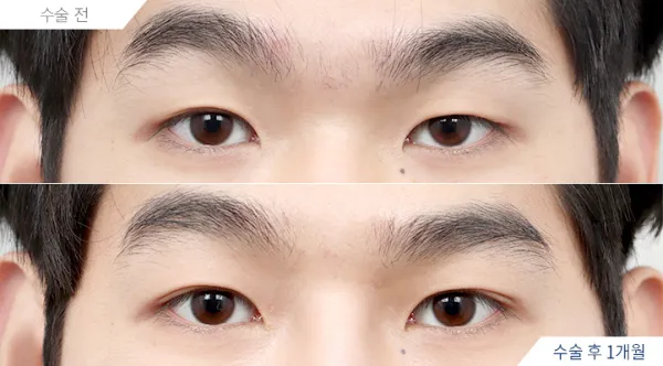 Before/After