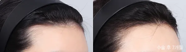 Before/After