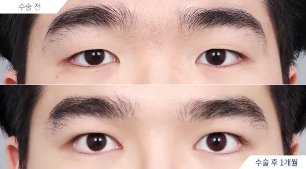 Before/After