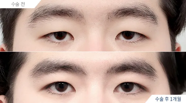 Before/After