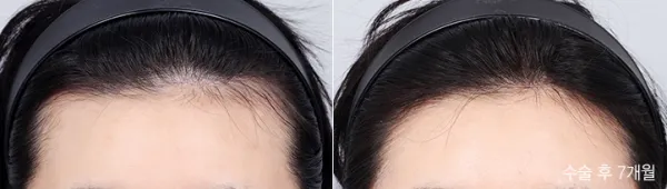 Before/After